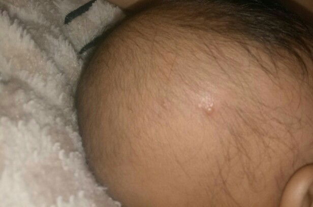 benjolan kecil di kepala baby