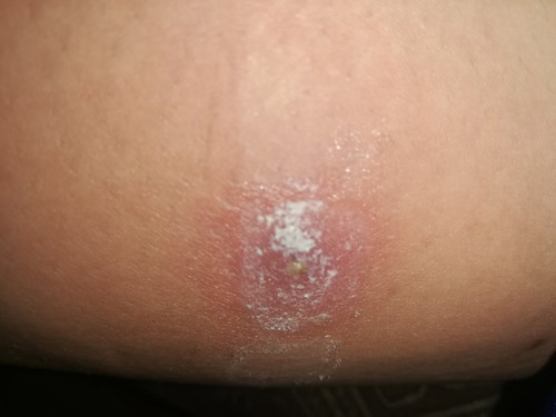 Skin Redness