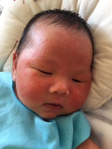 ผดผื่นบนใบหน้าลูก