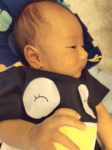 สิวทารก