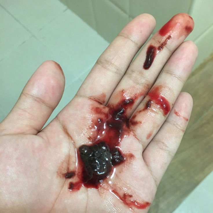 เลือดออกทางช่องคลอด