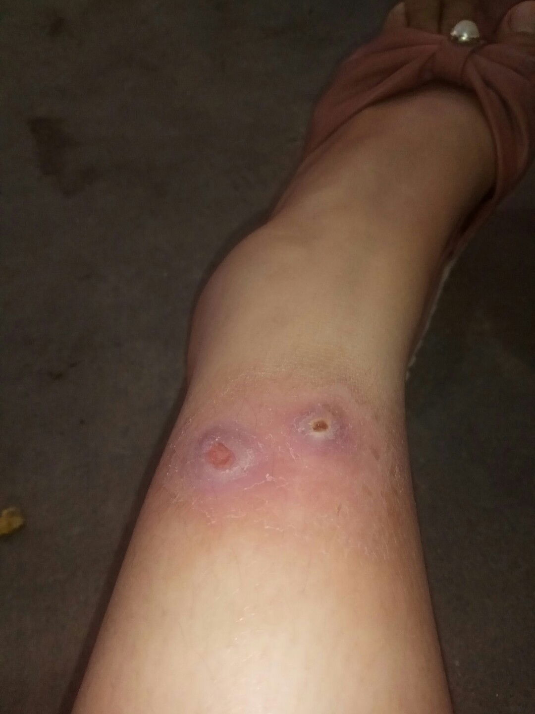 Luka kaki nggak sembuh sembuh