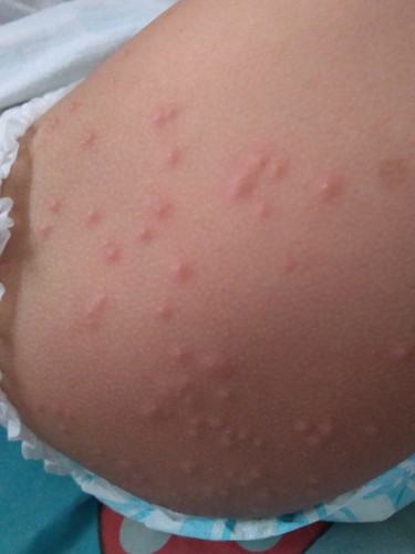 skin disease of toddler