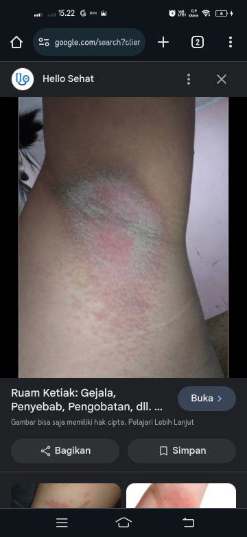 Obat untuk ruam / iritasi ketiak saat hamil