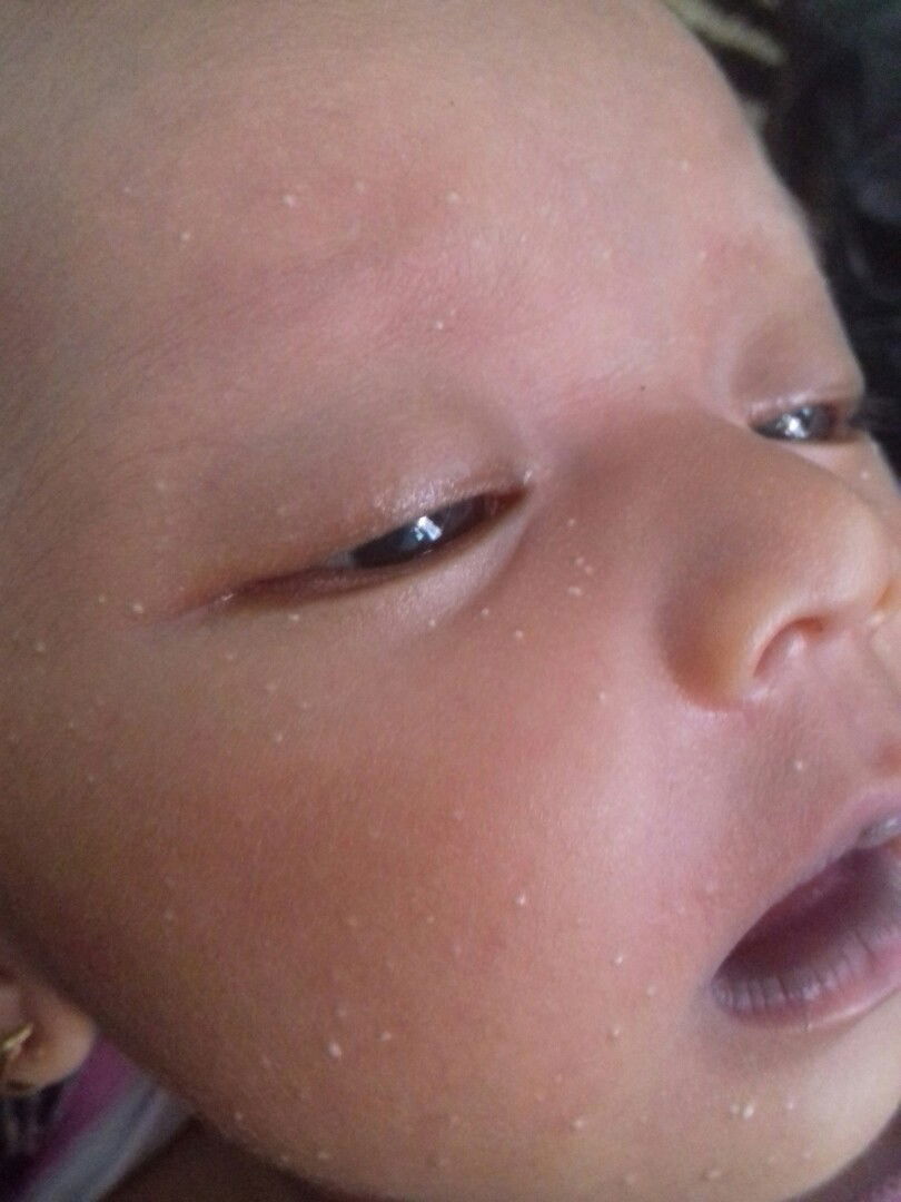 cara menghilangkan bintik putih