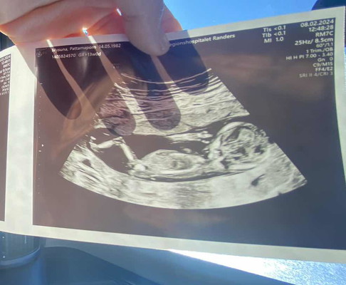 อุลตร้าซาวด์13 weeks