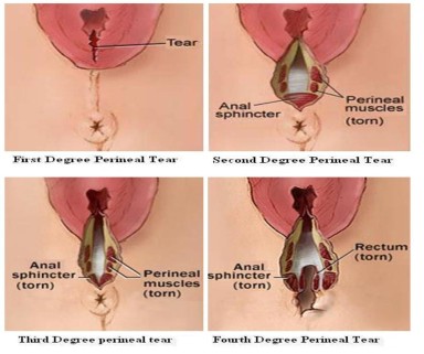 Episiotomy 3rd Degree