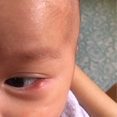 ตาบวม