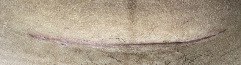 Jahitan operasi ceasar