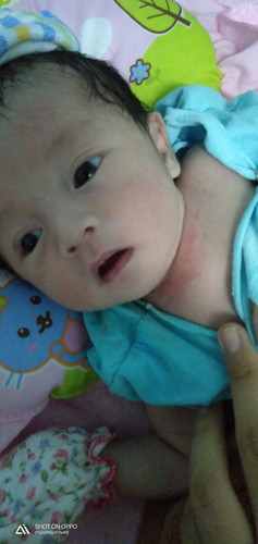 อยากถามว่าลูกเราเป็นผื่นที่คอเกิดจากอะไรค่า
