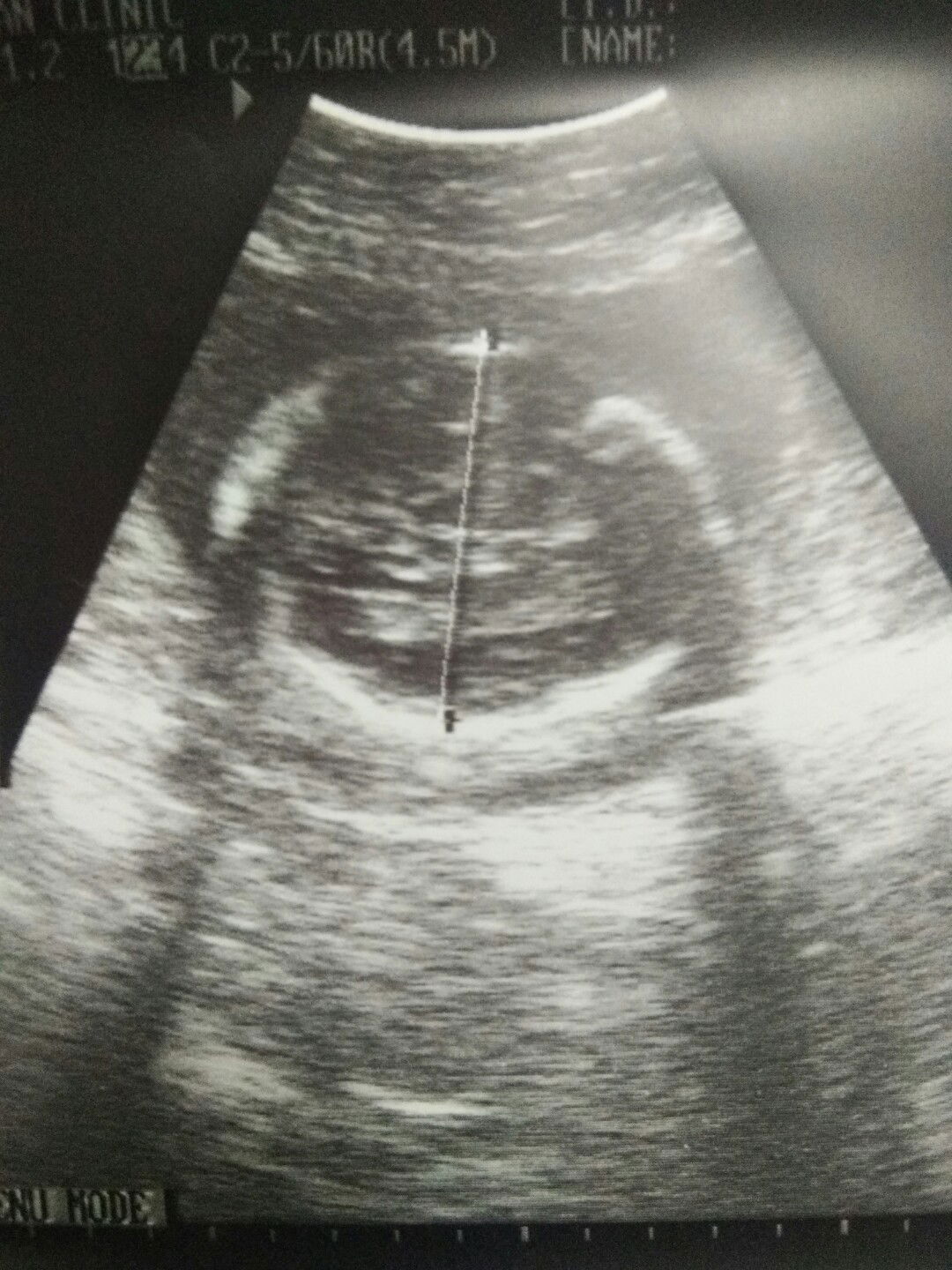 ผลอัลตร้าซาวด์