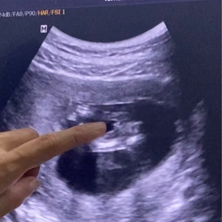 ท้องแรกค่ะ ดูไม่เป็นเลย น้อง12w5 d