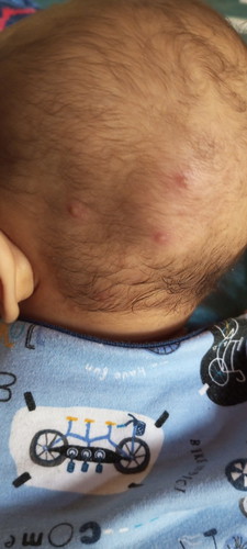 Benjolan nanah di kepala bayi