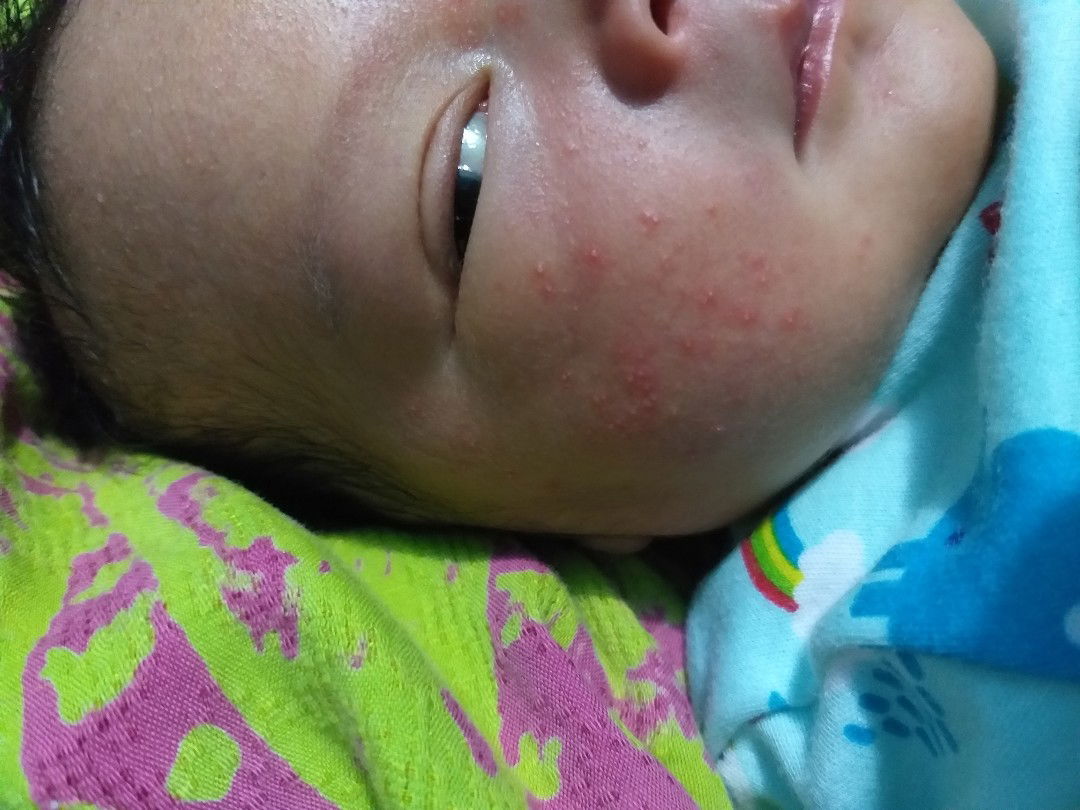 di muka merah beruntus