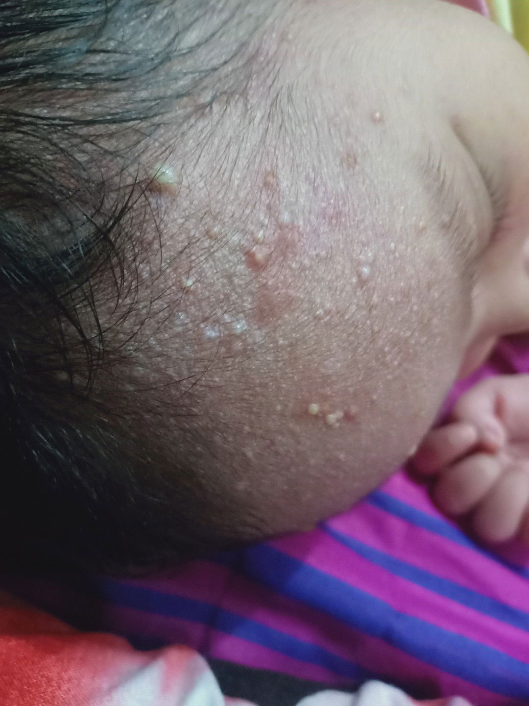 bintik bintik merah dan bernanah