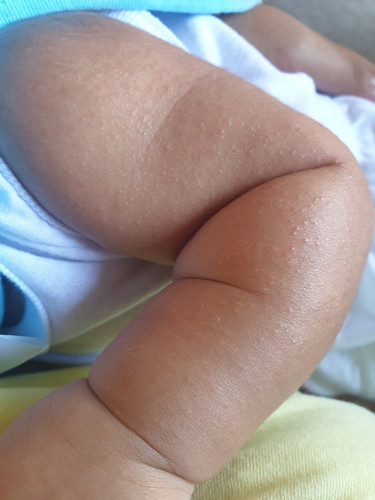 rashes ?
