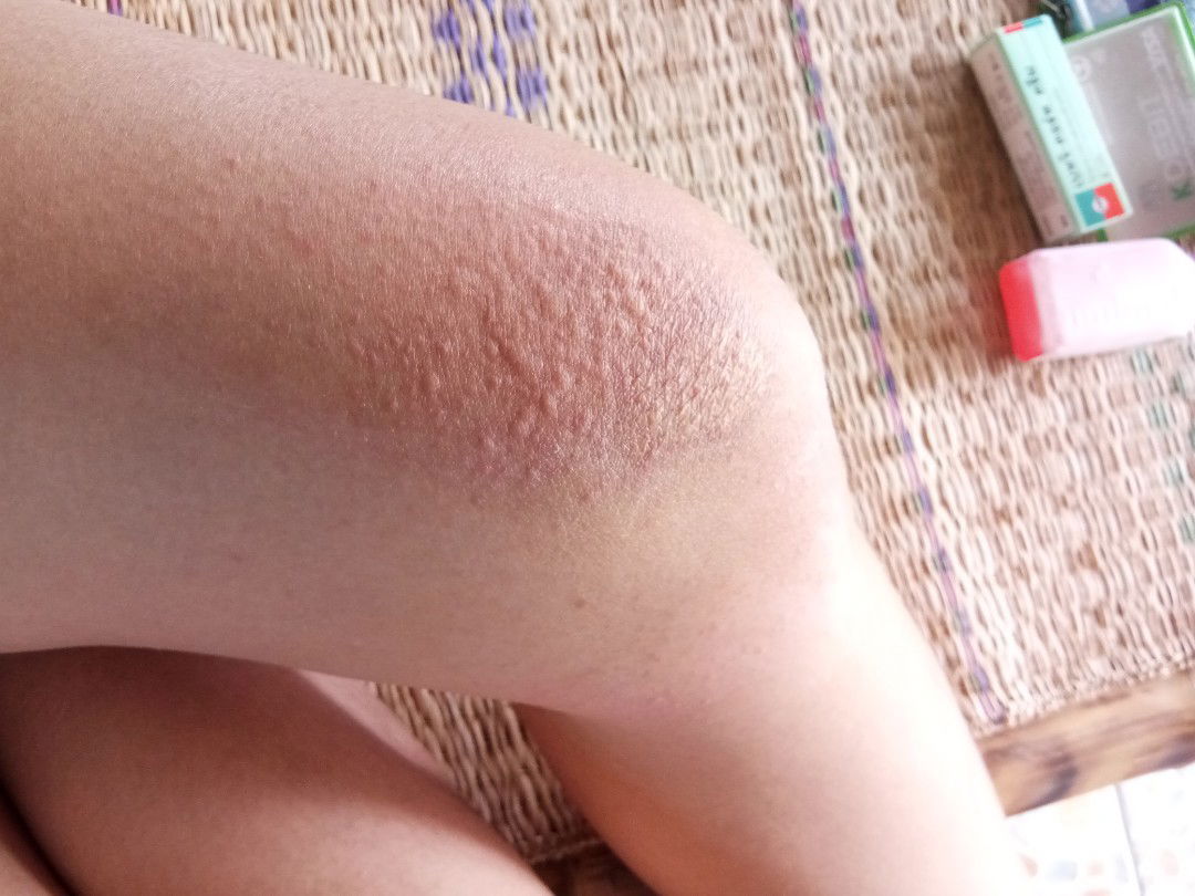 มีแม่ๆคนไหนเป็นบ้างมั้ยคะ อายุครรภ์32w5dแล้ว กังวลมากค่ะ