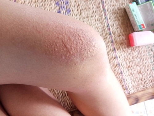 มีแม่ๆคนไหนเป็นบ้างมั้ยคะ อายุครรภ์32w5dแล้ว กังวลมากค่ะ