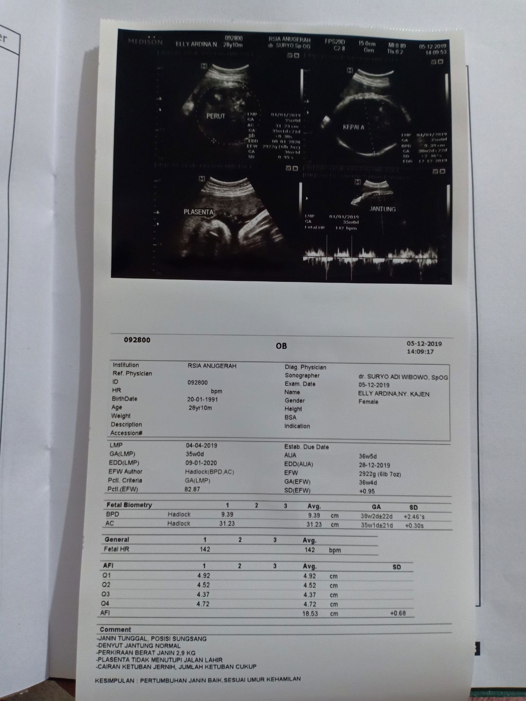 janin memutar posisi jadi sungsang saat sudah 35 w