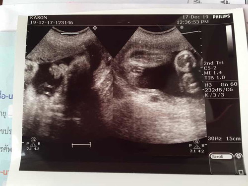 31 Week ลูกสาว.