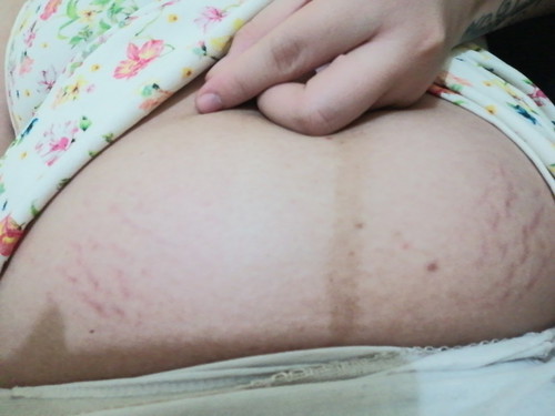 Stretch Marks