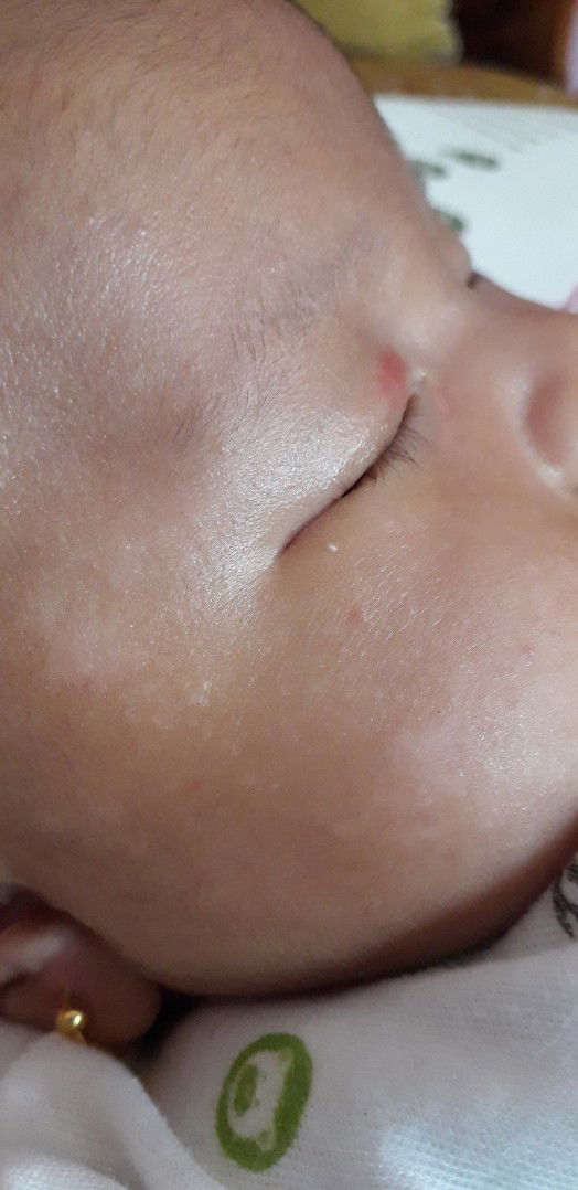 bercak putih bekas bruntusan