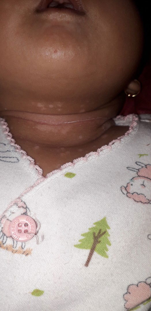 cara menghilangkan bercak putih di kulit muka dan leher bayi