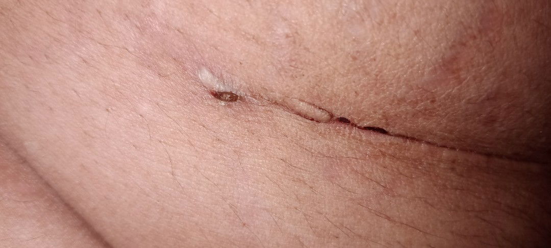 Bund ada yg pernah mengalami seperti saya???? Saya op SC hampir 3 minggu ini