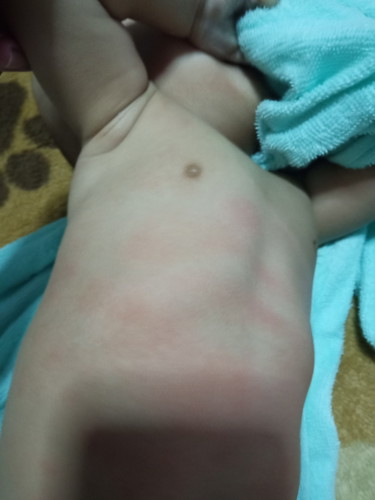 แม่ๆบ้านไหนน้องเป็นผื่นแบบนี้บ้างค่ะ