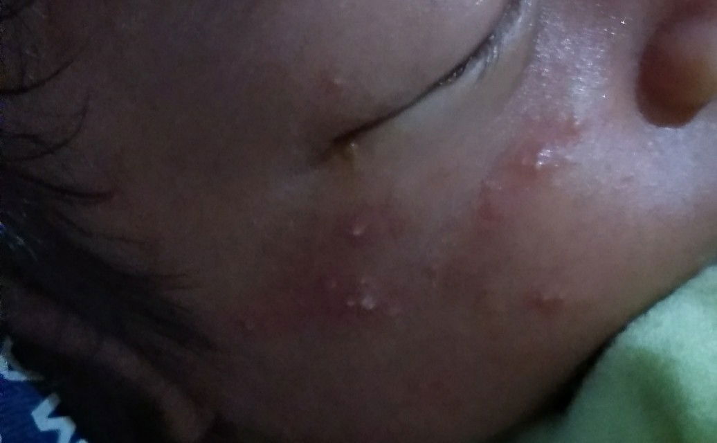 bintik2 pada wajah bayi