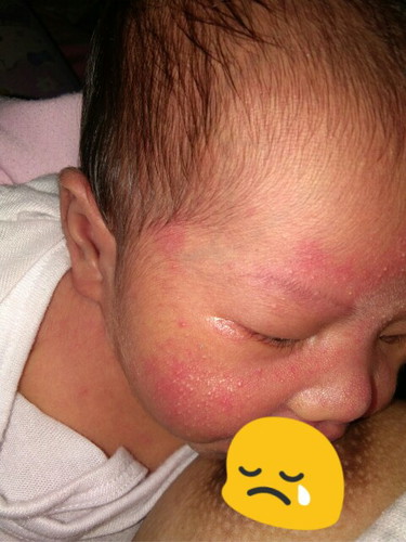 rash