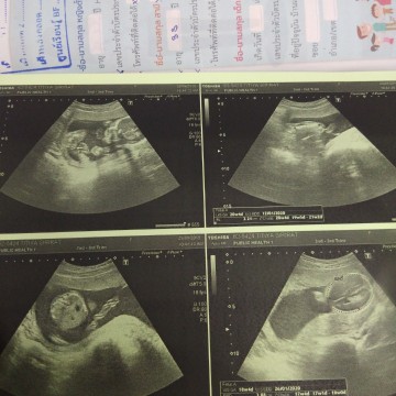 น้ำหนักลูกดูตรงไหนค่ะ..พอดีหมอไม่ได้บอก