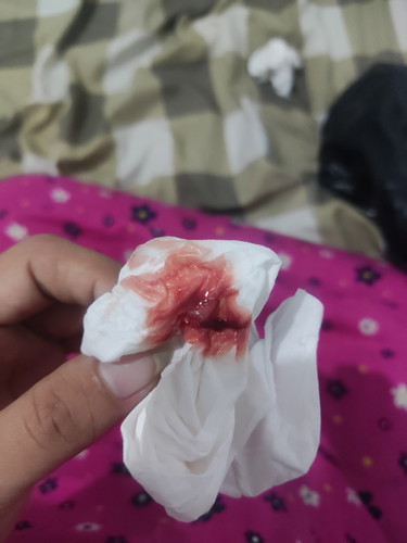 Hamil 38 Minggu udah keluar ngflek kayak gini 1 Minggu lebih , tp masih diiringi kontraksi palsu