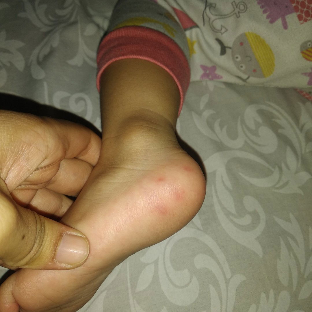 bintik merah telapak kaki