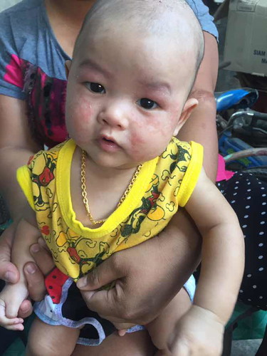 เเพ้อะไรไม่รู้