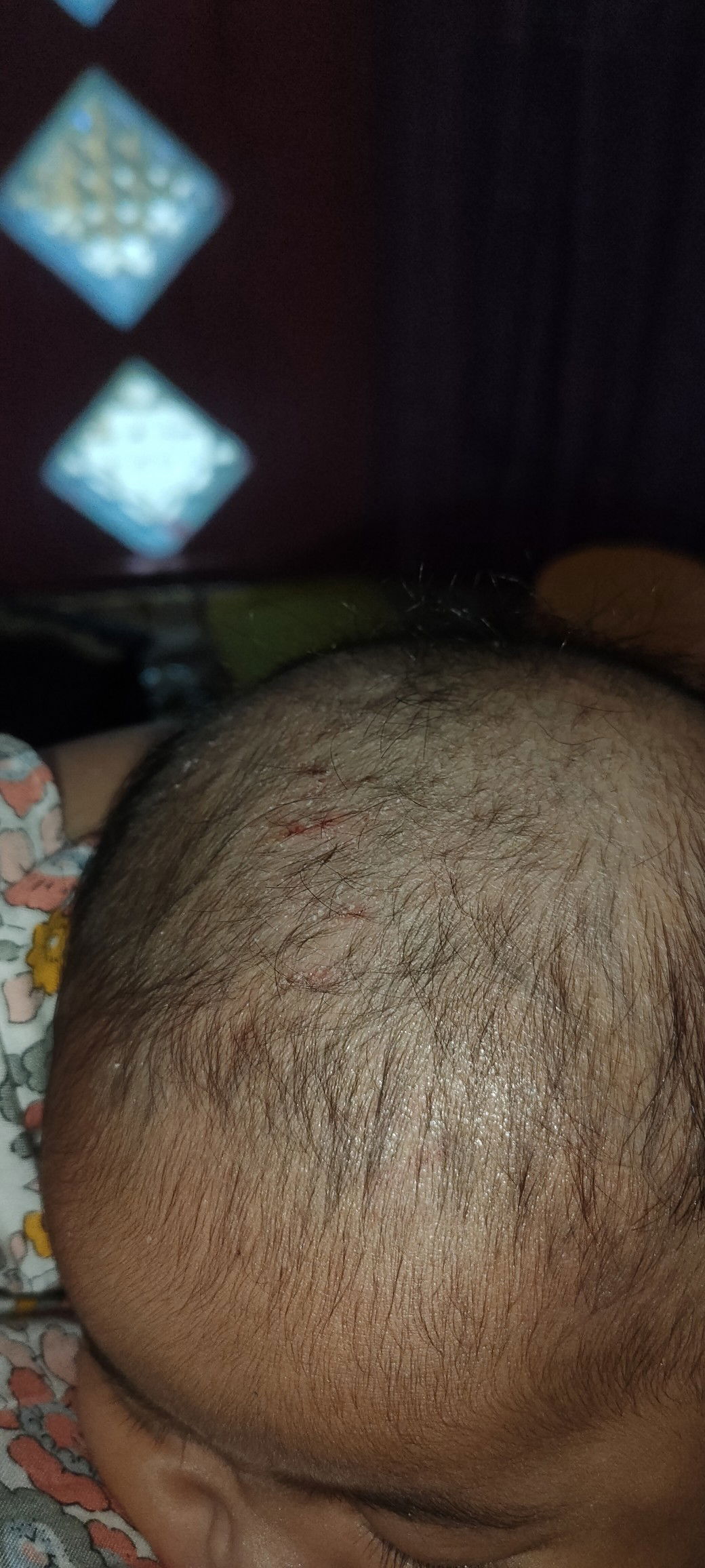 Kulit kepala bayi kering bersisik