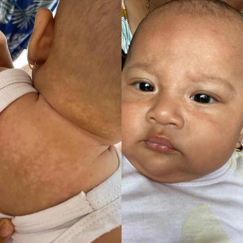 Bercak putih di wajah