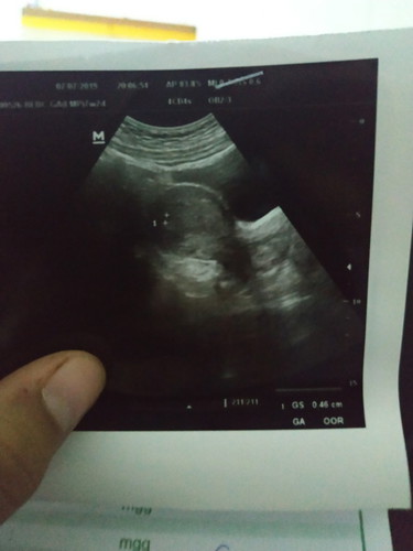 janin belum terlihat