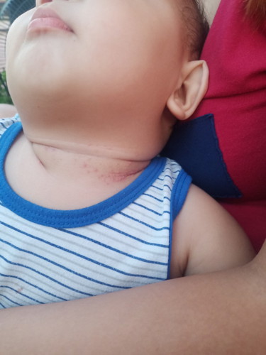 rashes