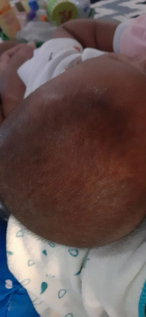 kulit kepala baby seperti ber ketombe