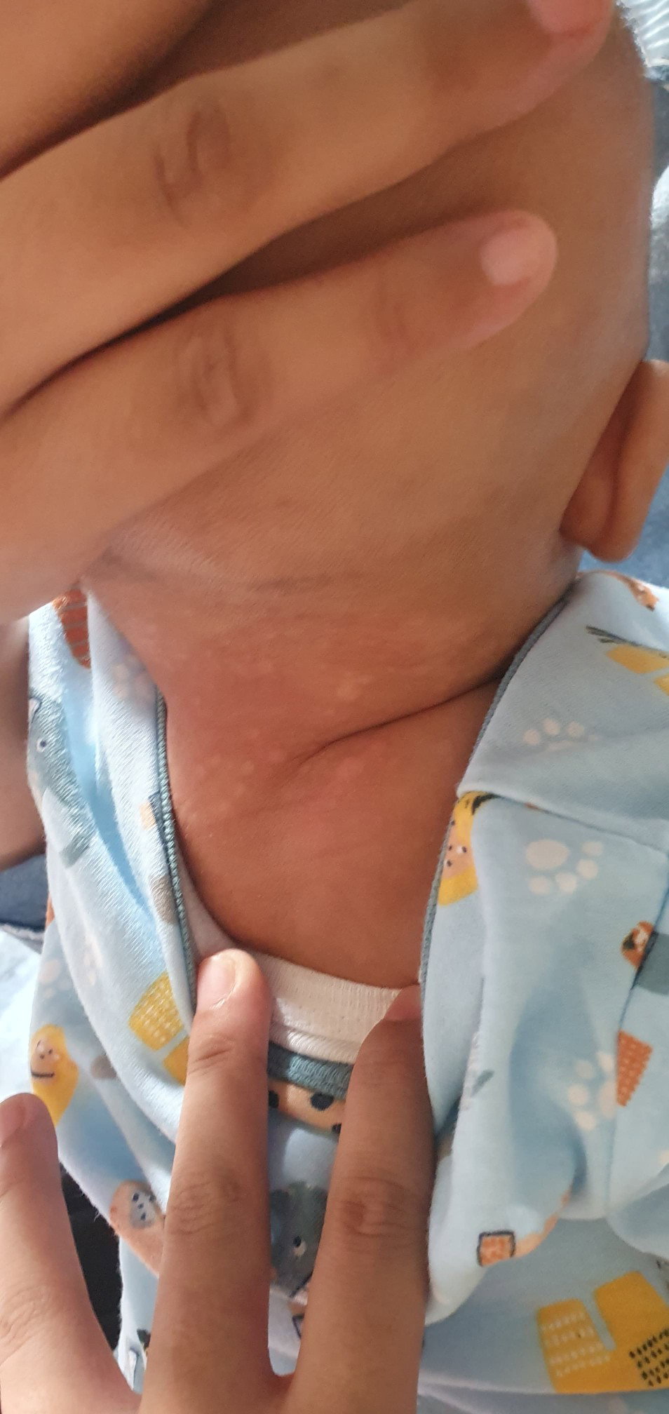 Ada yg tau ga ya anak aku kenapa? Awalnya cuman bercak merah kirain bentol lama2 jadi putih melebar