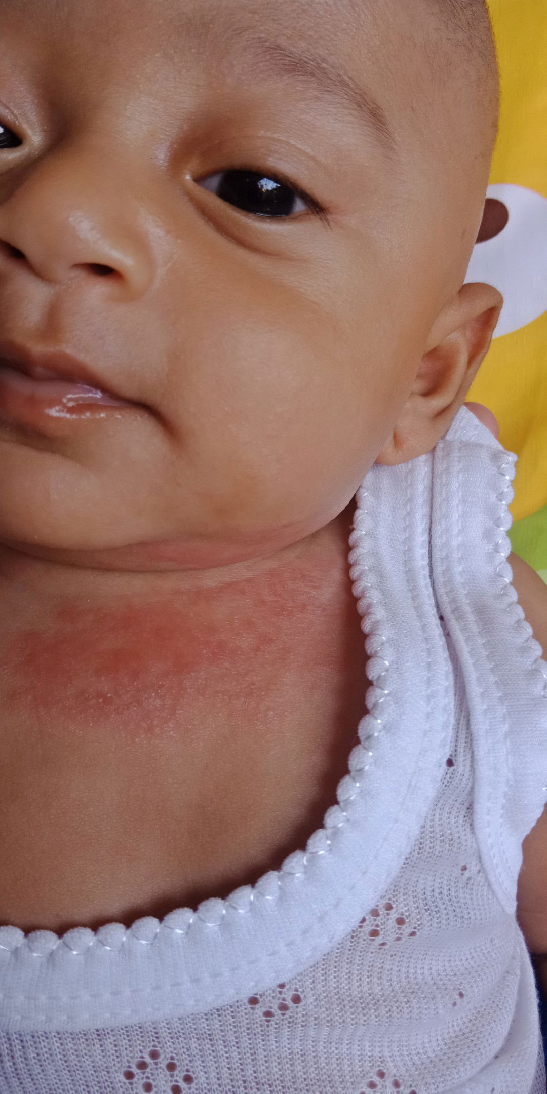 gatal pada bayi 3 bulan