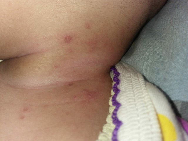 melenting isi air, atau bintil2 kecil gitu..