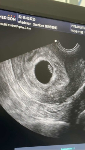 มีแม่ๆคนไหนหัวใจลูกเต้นช้าไหมคะ