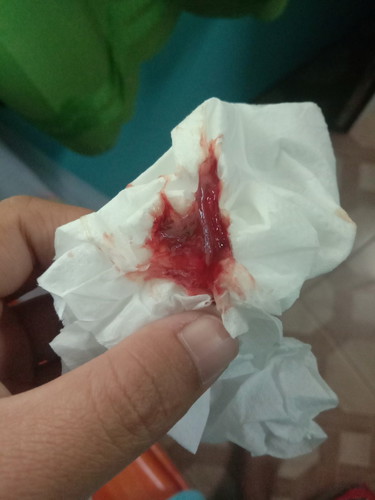 กระตุ้นปากมดลูก