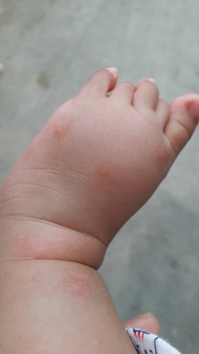 น้องมีตุ่มใสๆขึ้นแบบนี้เป็นอะไรครับ.ใครรู้บอวิธีแก้หน่อยครับ