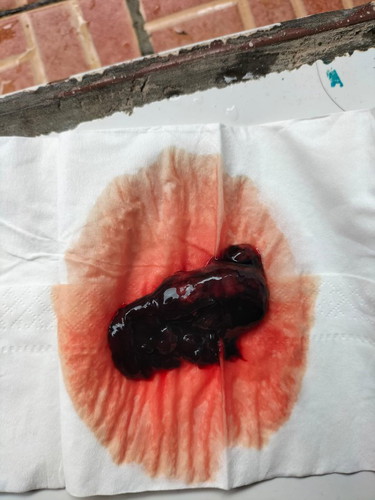 HPHT 4 januari, perdarahan usia 5w3d