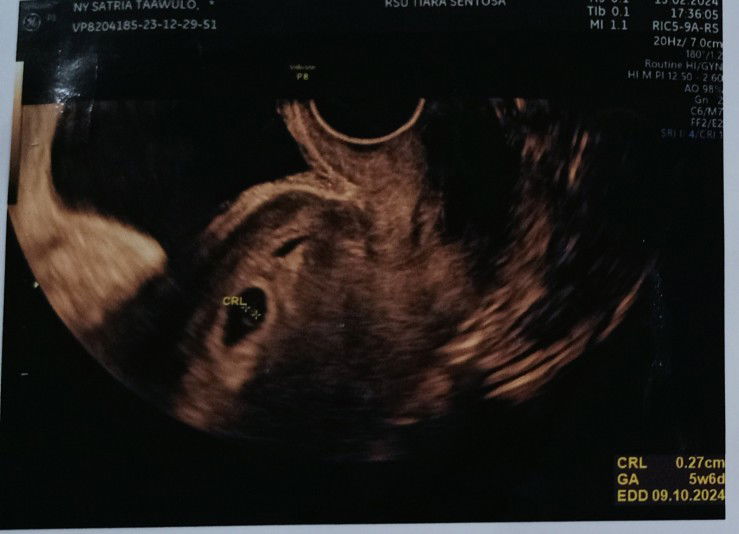 USG pertama, USG trans V