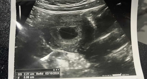 Pregnant 6w6d tapi kantung seems like masih kosong
