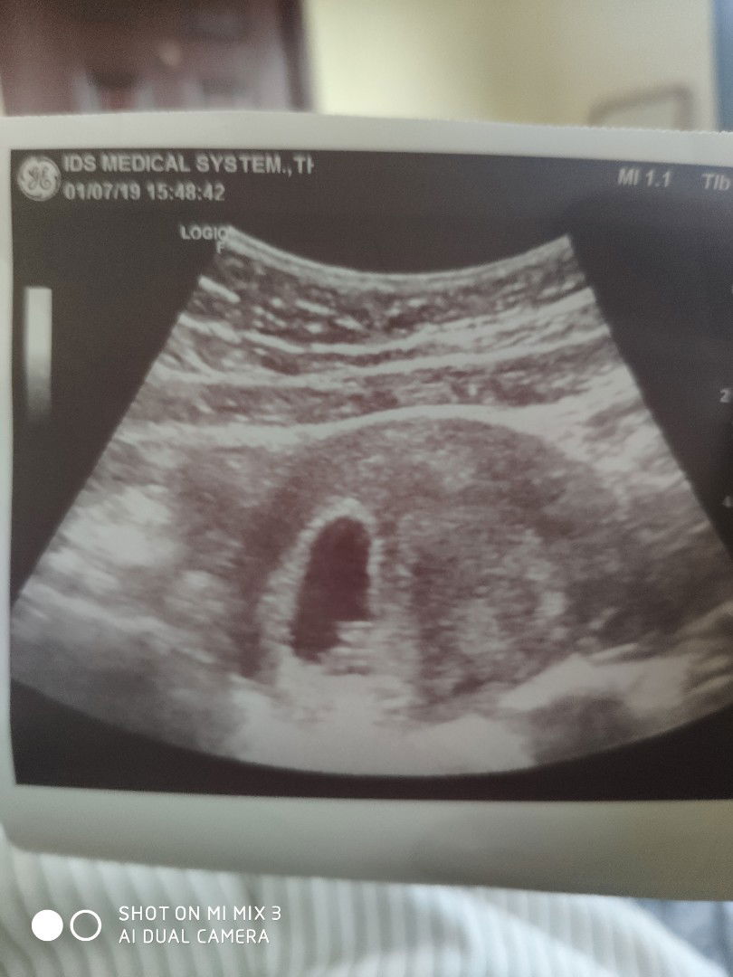 อัลตร้าซาวด์น้อง